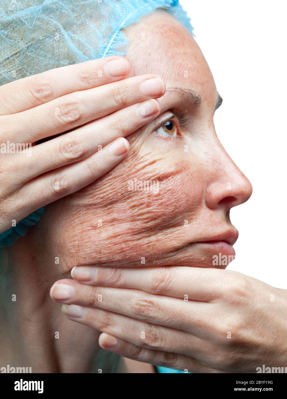 Chemical peeling. Parchment skin before rejectio Stock Photo Alamy