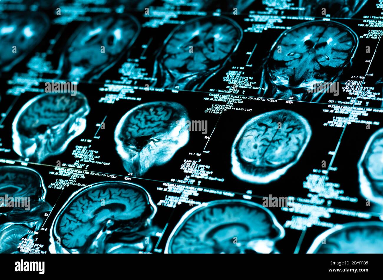 Mri scan head injury hi-res stock photography and images - Alamy