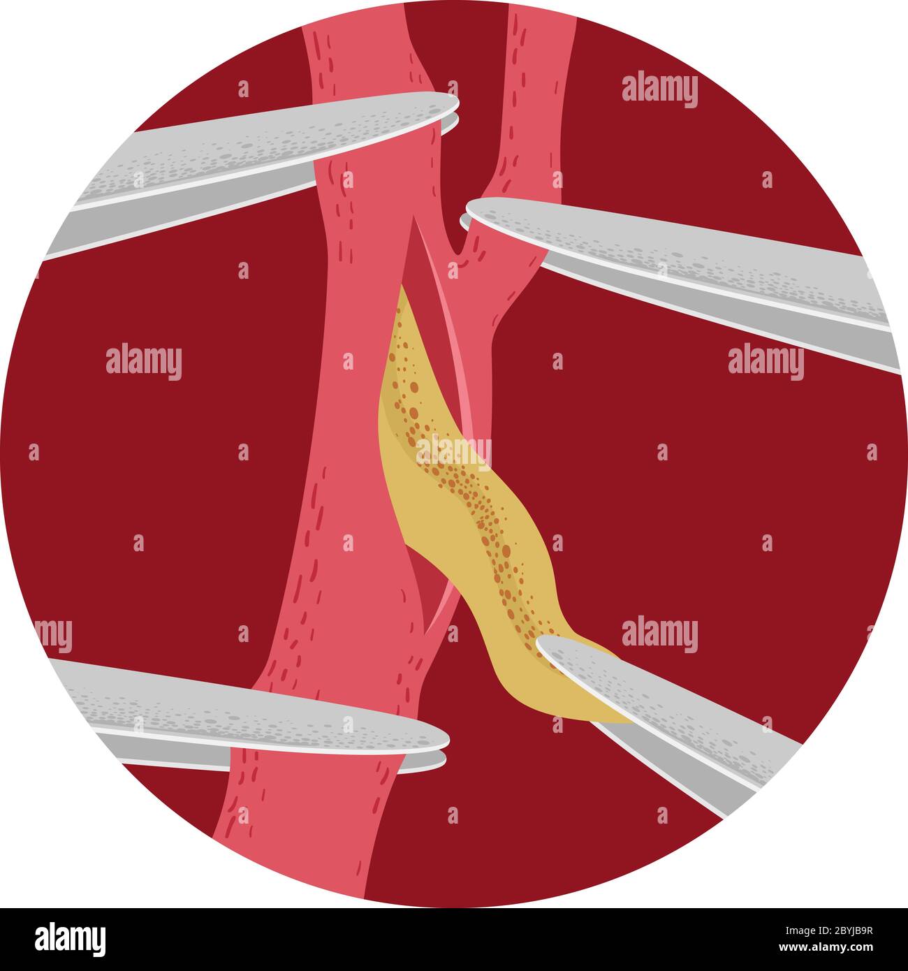 ultrasound-picture-carotid-artery-arteria-carotis-stockfoto-512017165