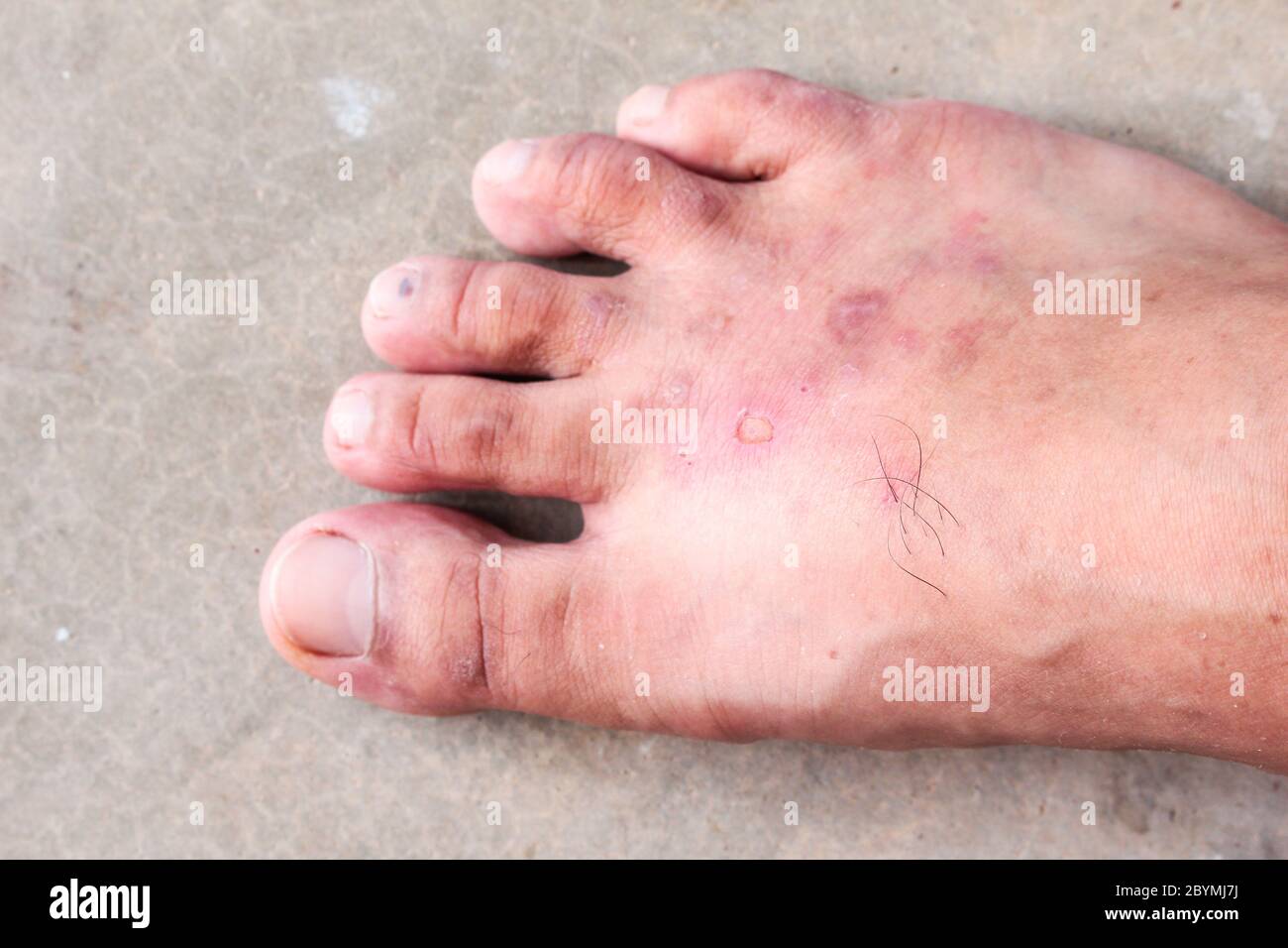 closeup skin athlete’s foot psoriasis fungus, hong kong foot, foot