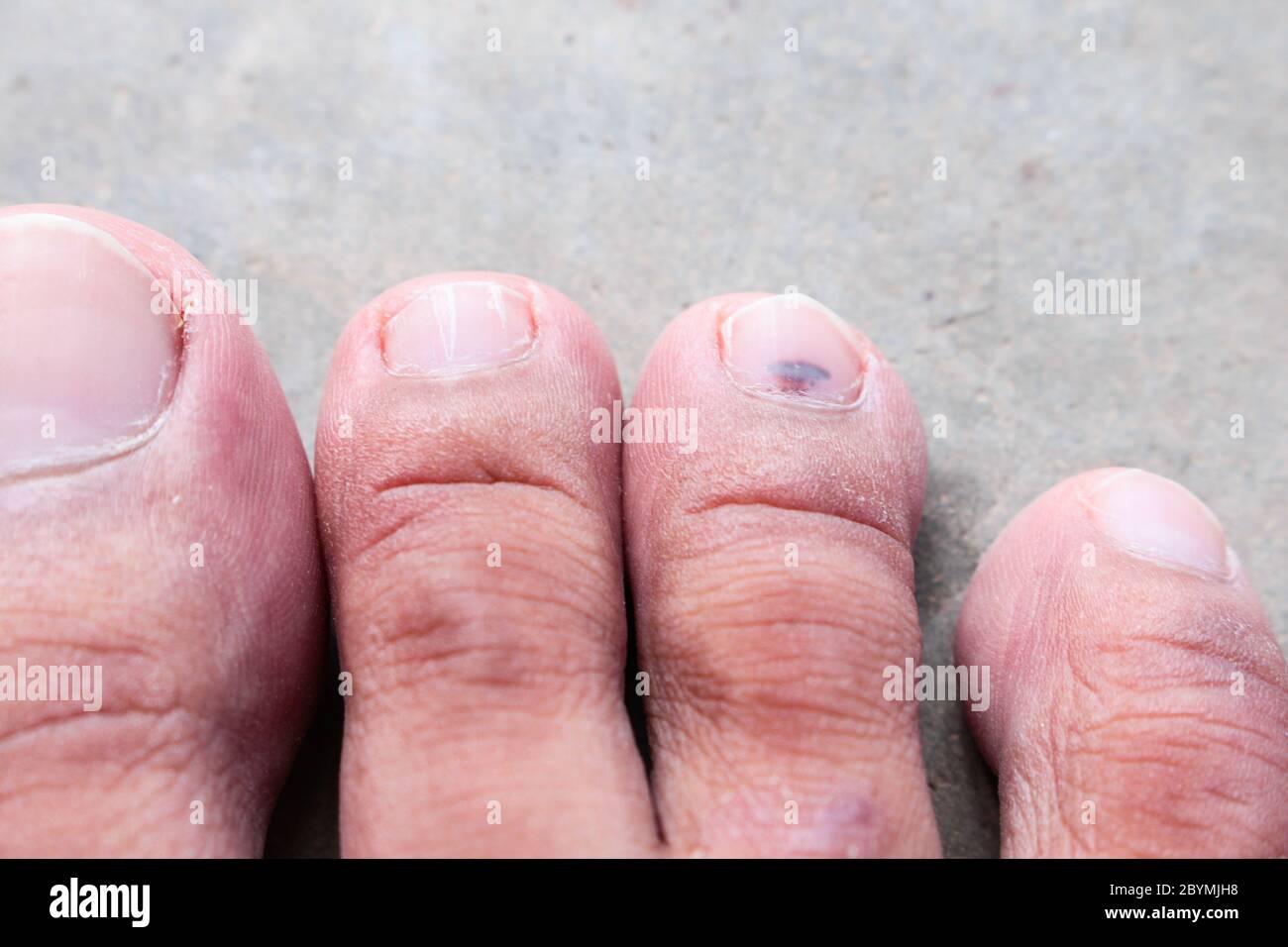 closeup skin athlete’s foot psoriasis fungus, hong kong foot, foot