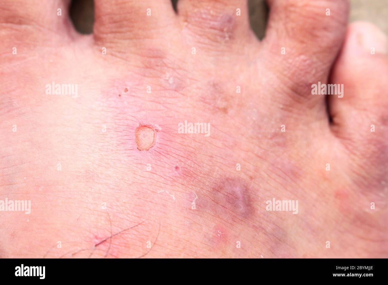closeup skin athlete’s foot psoriasis fungus, hong kong foot, foot