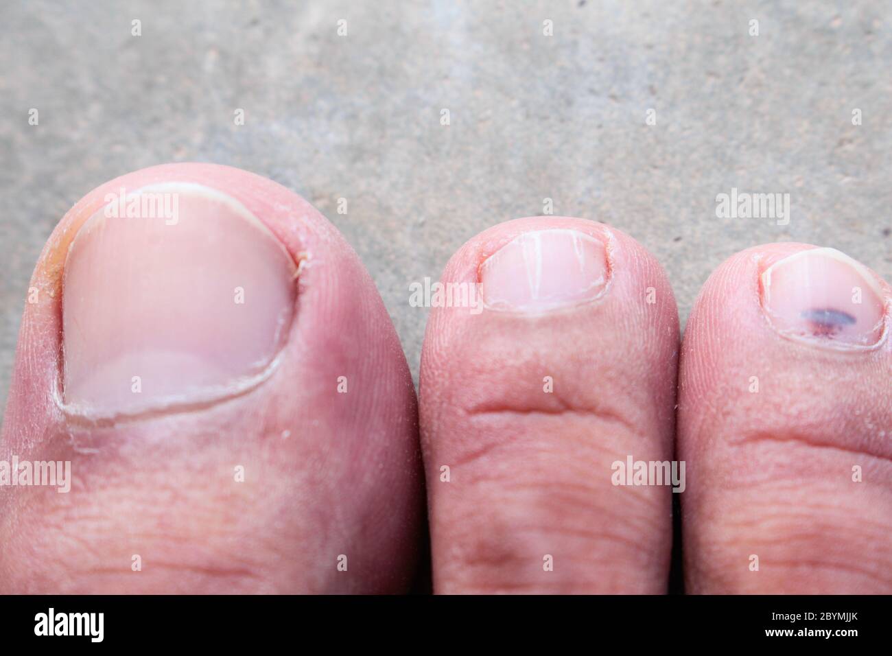 closeup skin athlete’s foot psoriasis fungus, hong kong foot, foot