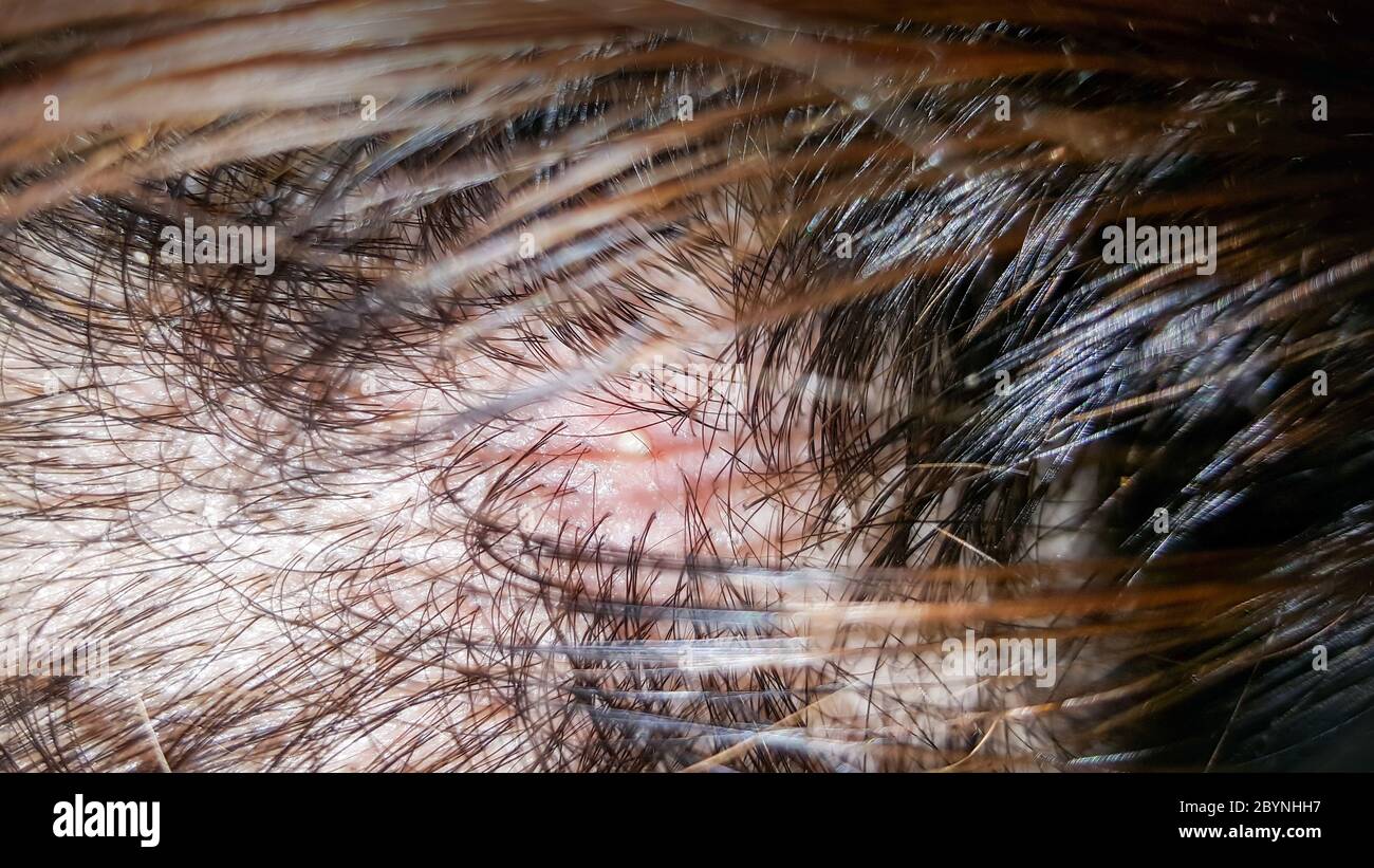 abscess on skin head Stock Photo Alamy
