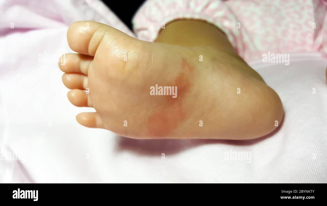 closeup newborn baby feet skin athlete’s foot psoriasis fungus, hong