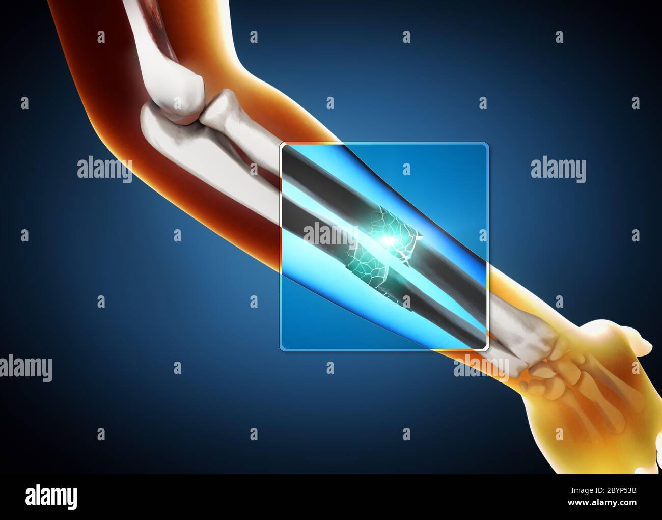 3d illustration of a x-ray image of a broken ulna and radius bone Stock Photo