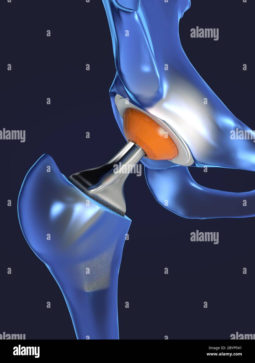 Function of a hip joint implant or hip prosthesis in frontal view - 3d illustration Stock Photo