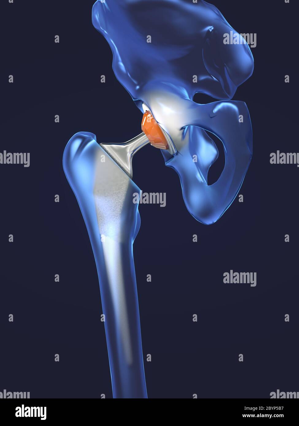 Function of a hip joint implant or hip prosthesis in frontal view 3d