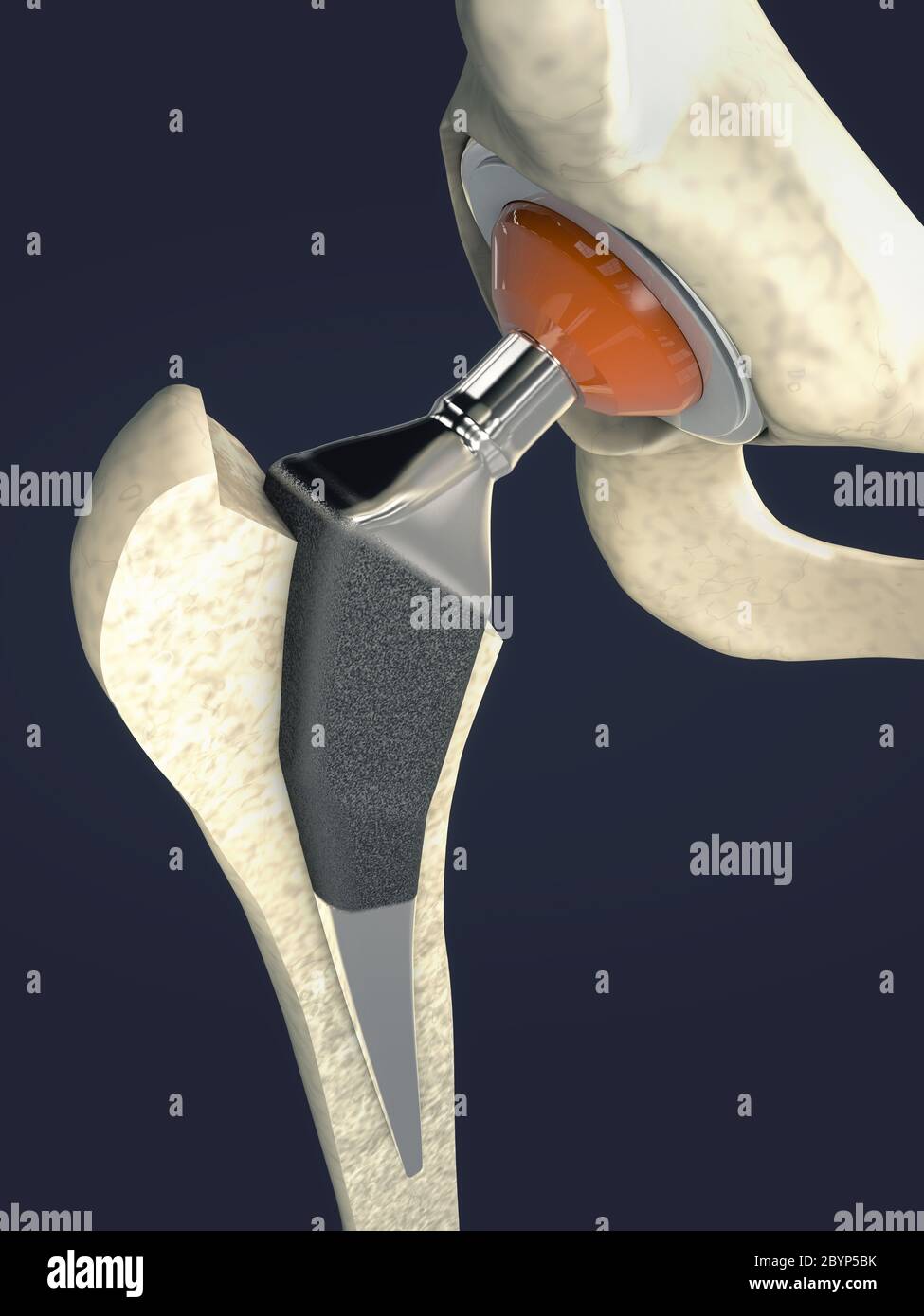 Function of a hip joint implant or hip prosthesis in frontal view 3d