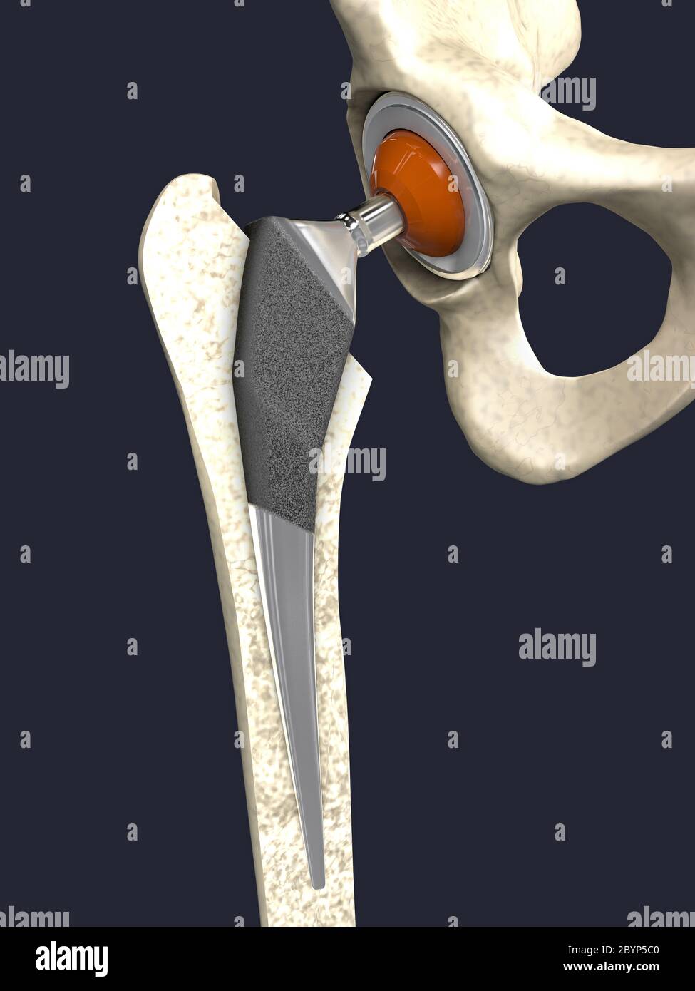 Function Of A Hip Joint Implant Or Hip Prosthesis In Frontal View 3d