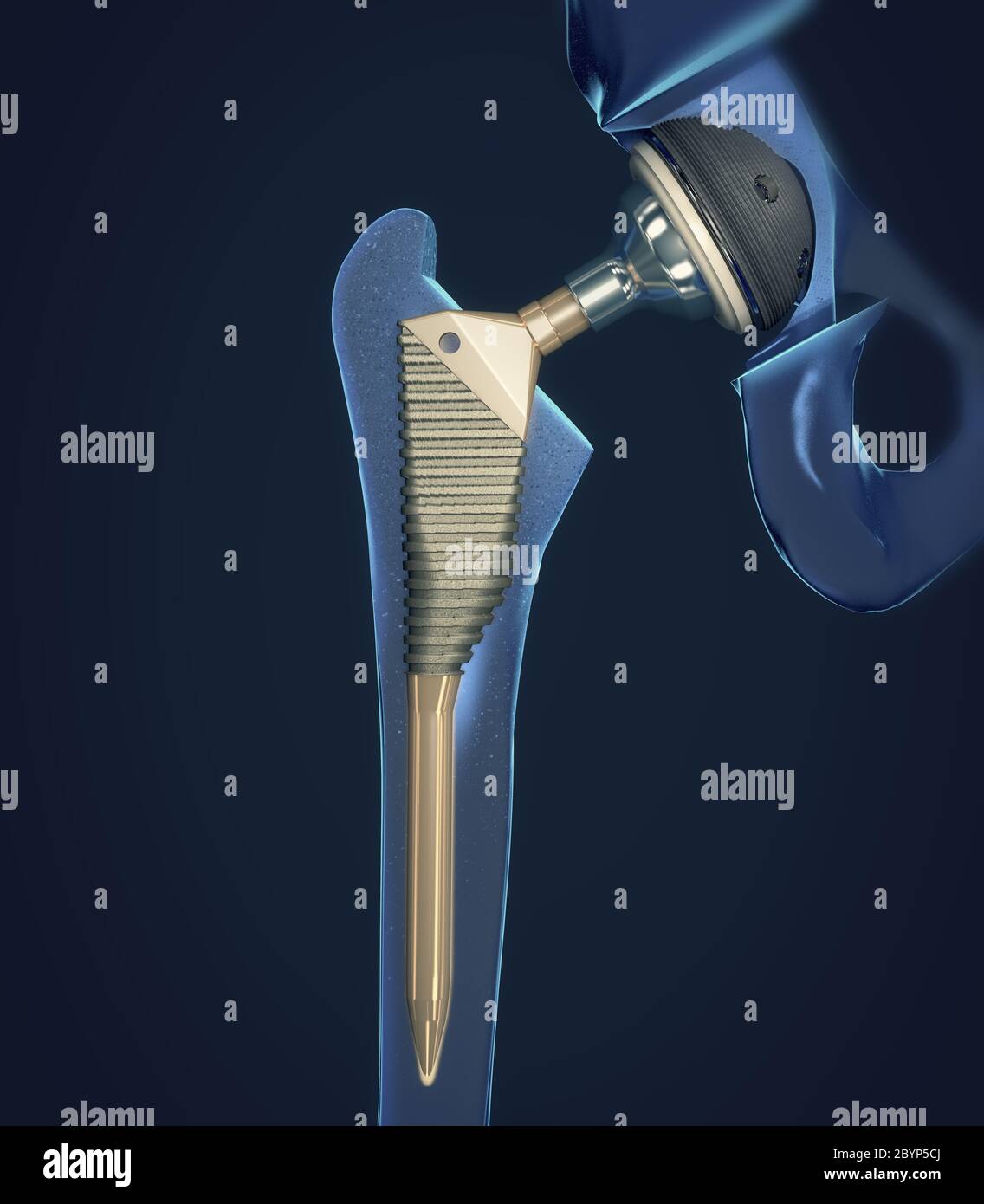 Titanium implant hires stock photography and images Alamy