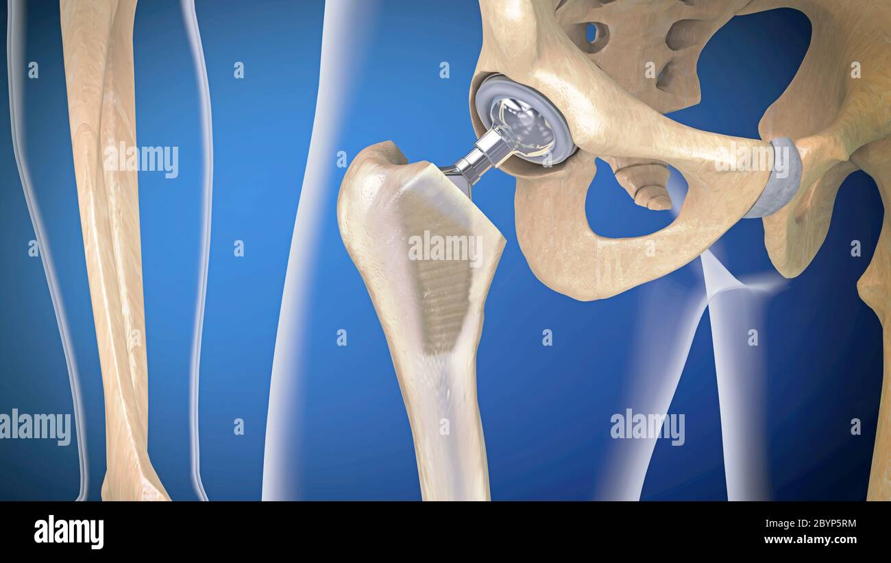 Function of a hip joint implant or hip prosthesis in frontal view - 3d illustration Stock Photo