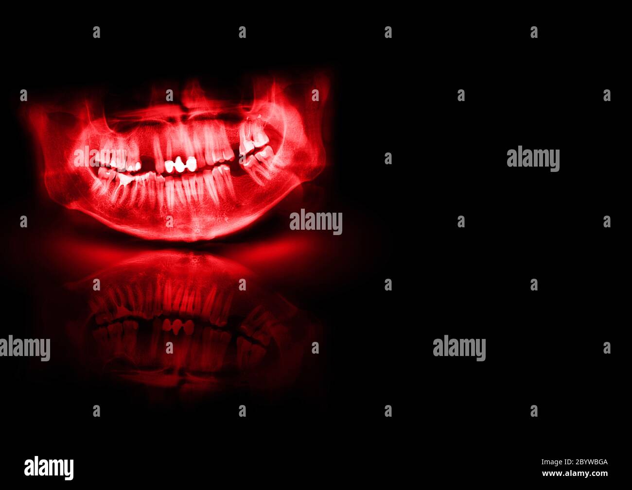 Panoramic radiograph is a scanning dental Xray of the upper jaw