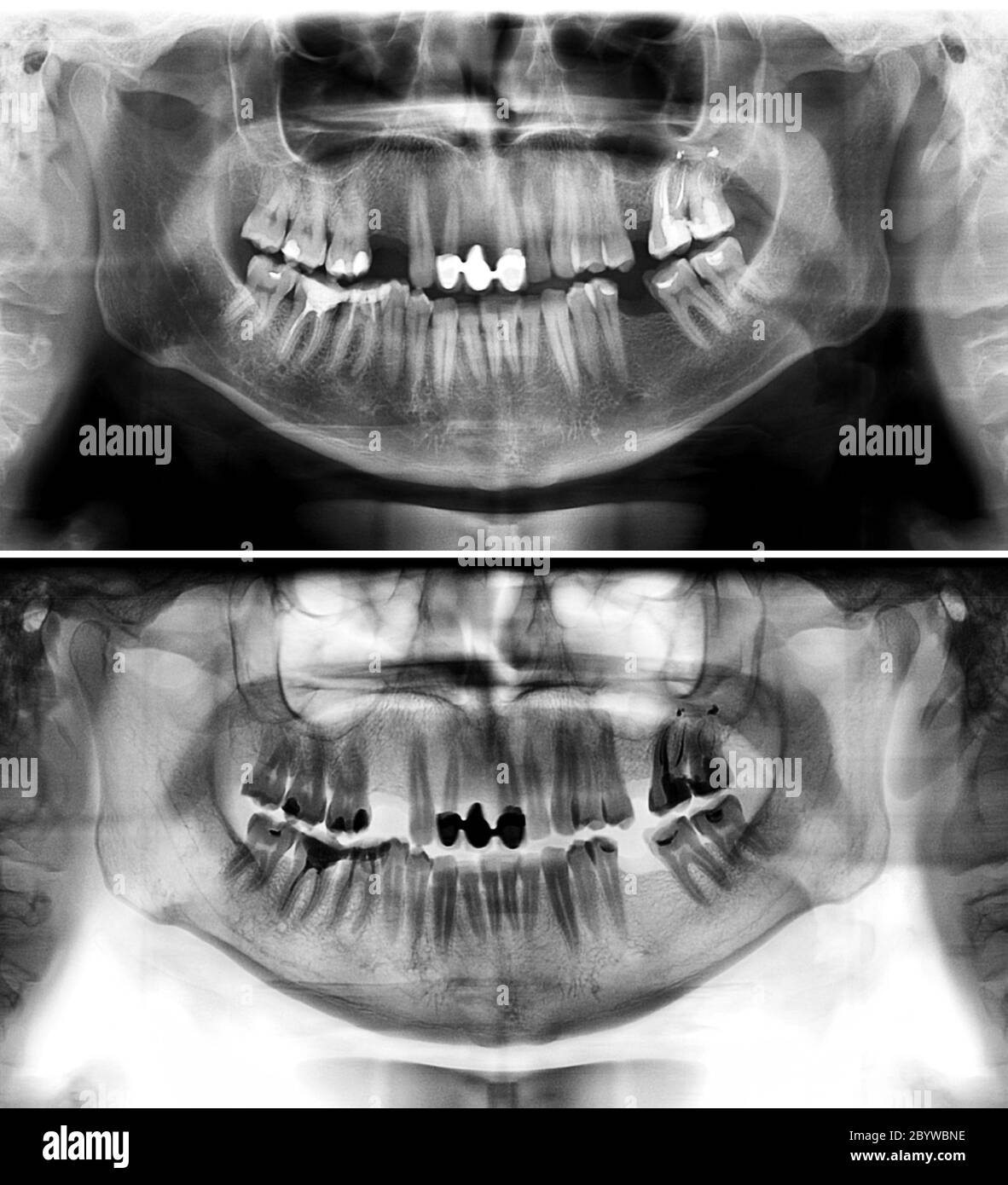 Panoramic radiograph is a scanning dental X-ray of the upper jaw maxilla and lower jawbone mandible. The photo shows a young man aged thirty seven 37 Stock Photo