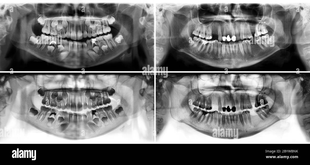 Panoramic radiograph is a scanning dental X-ray of the upper jaw maxilla and lower jawbone mandible. The photo shows a young man aged thirty seven 37 Stock Photo