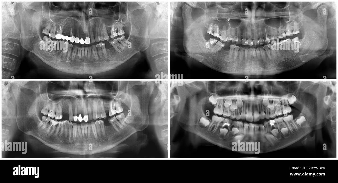 Panoramic dental x-ray digital image of upper and lower jaw. Radiograph scanning of maxilla and mandible. Focal plane tomography to thirty-year-old wo Stock Photo