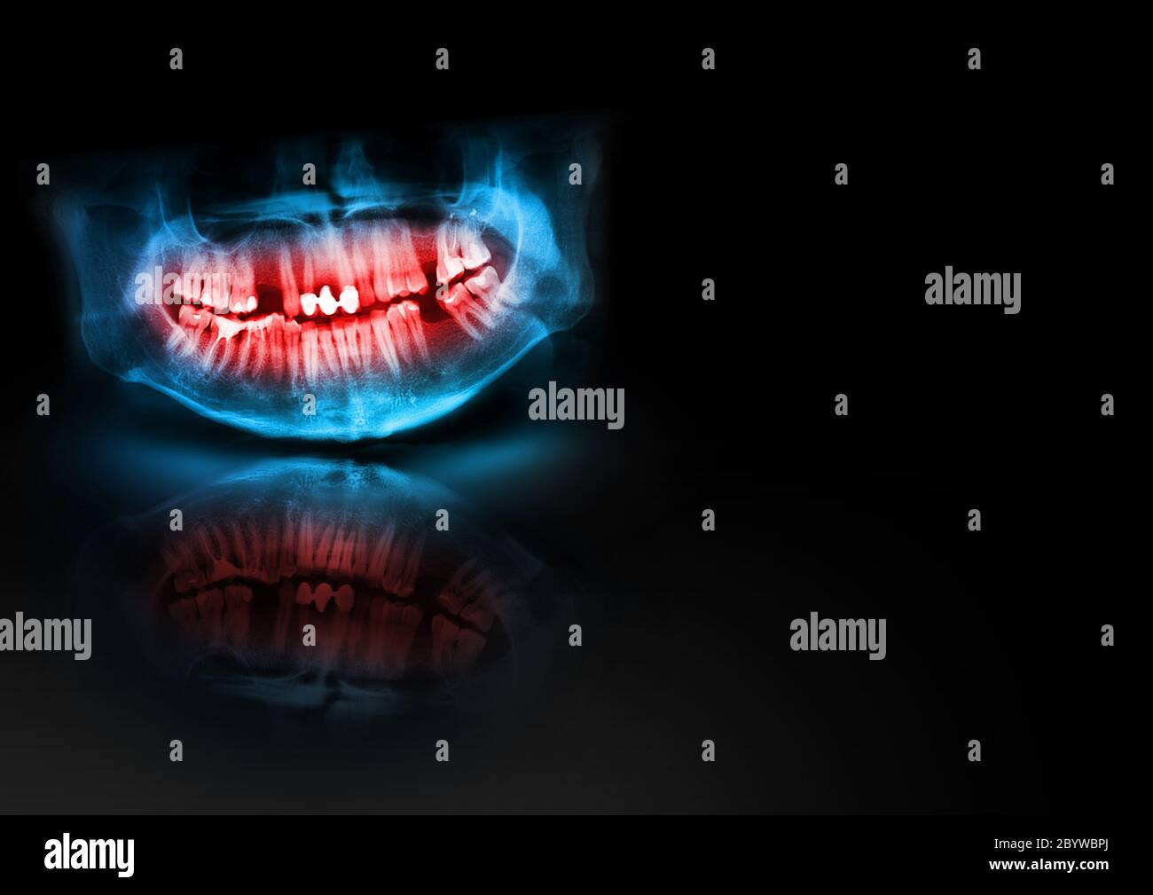 Panoramic radiograph is a scanning dental X-ray of the upper jaw maxilla and lower jawbone mandible. Black background with with glow, shadow and refle Stock Photo