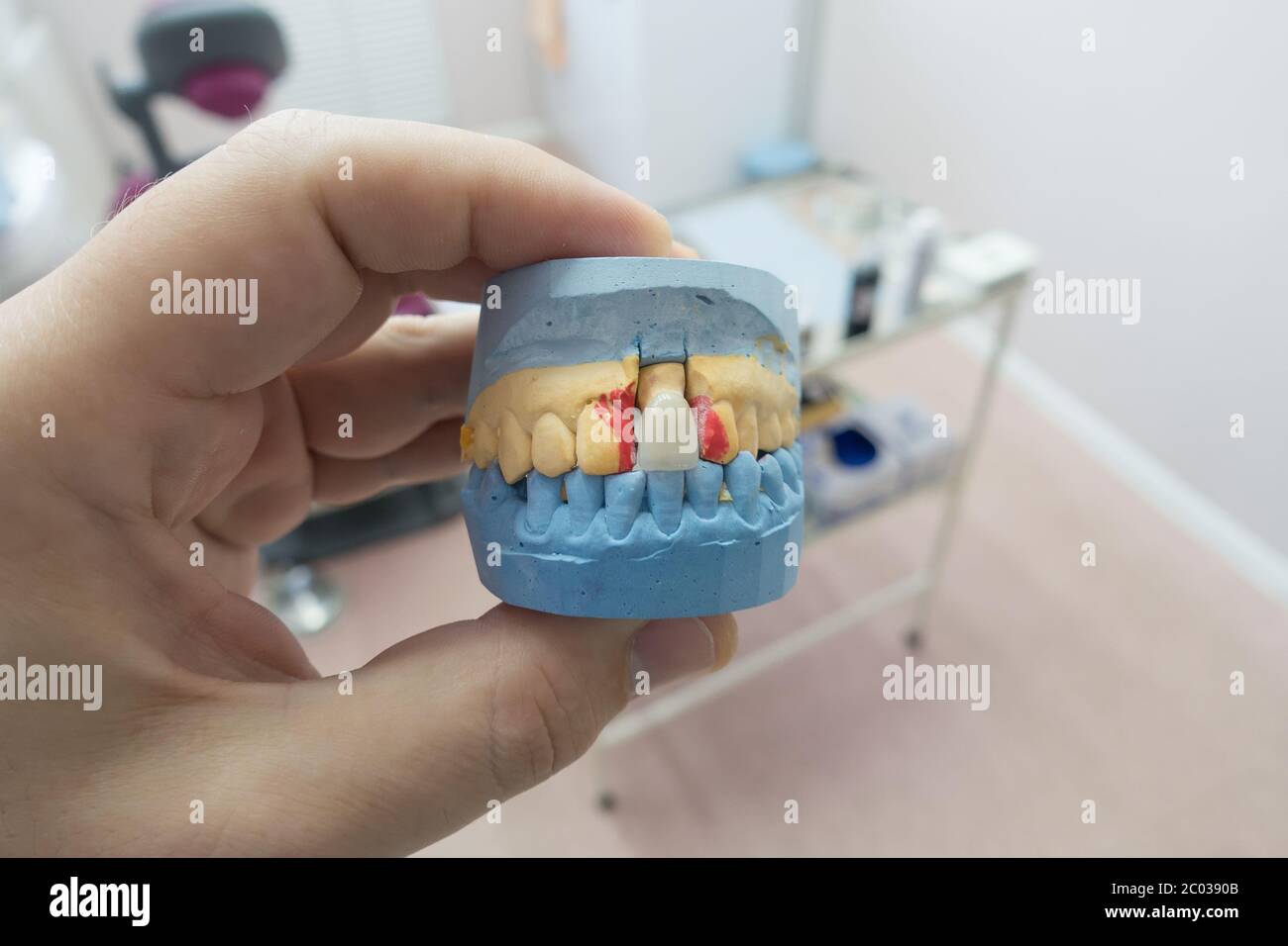 dental ceramicmetal crowns on a plaster model in the doctor’s hands