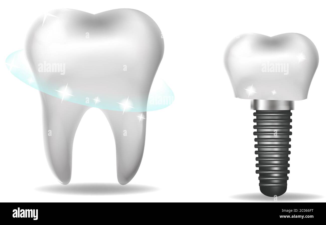 Dental implants, prosthetics 3D realistic style. Dentistry, healthy