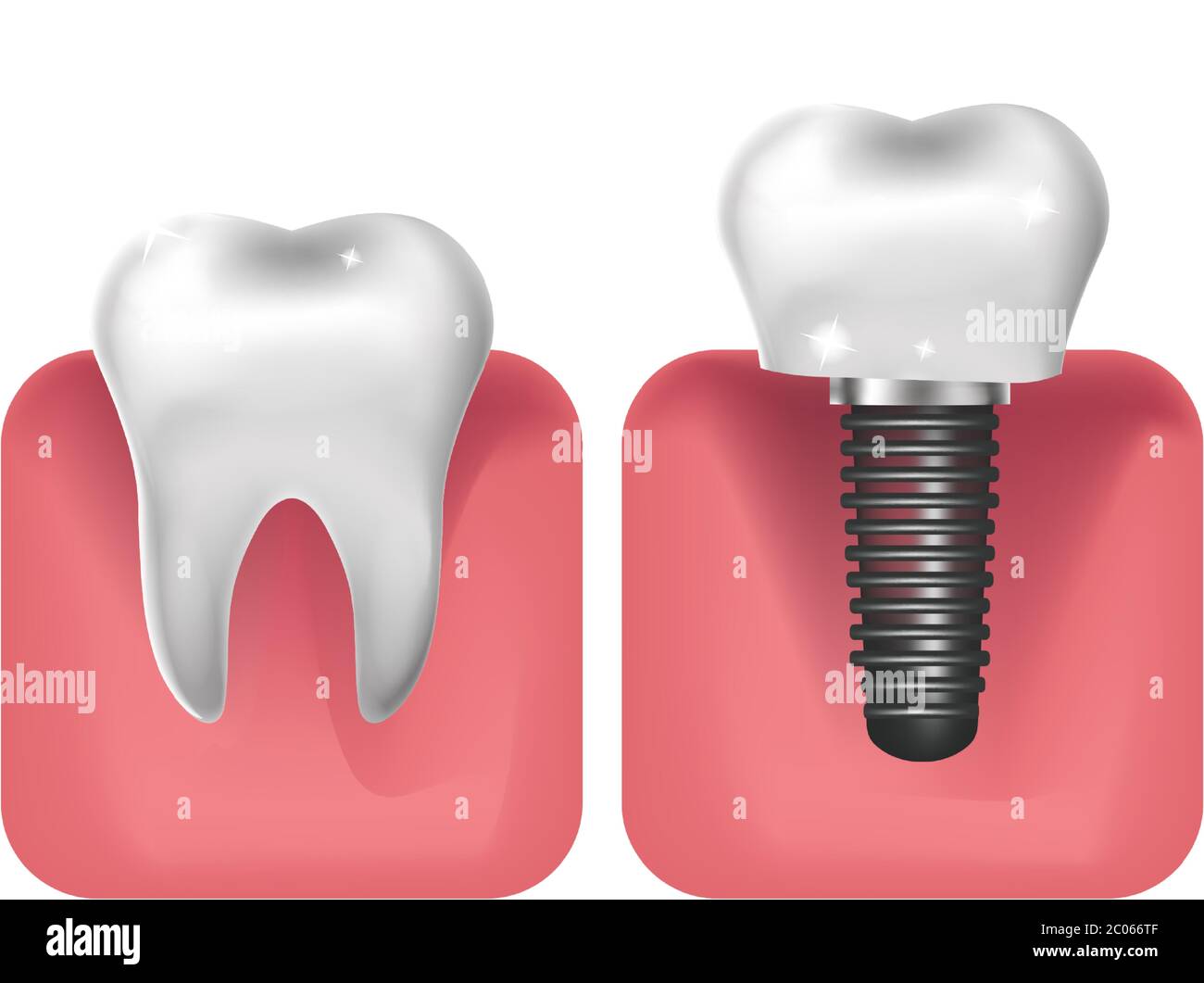 Dental implants, prosthetics 3D realistic style. Dentistry, healthy