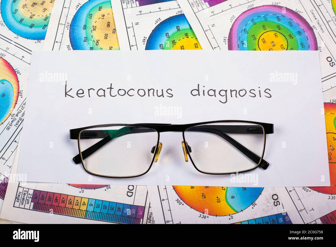 Kiev, Ukraine - 07.07.2019 diagnosis keratoconus, corneal disease, topograms of cornea and glasses. Stock Photo