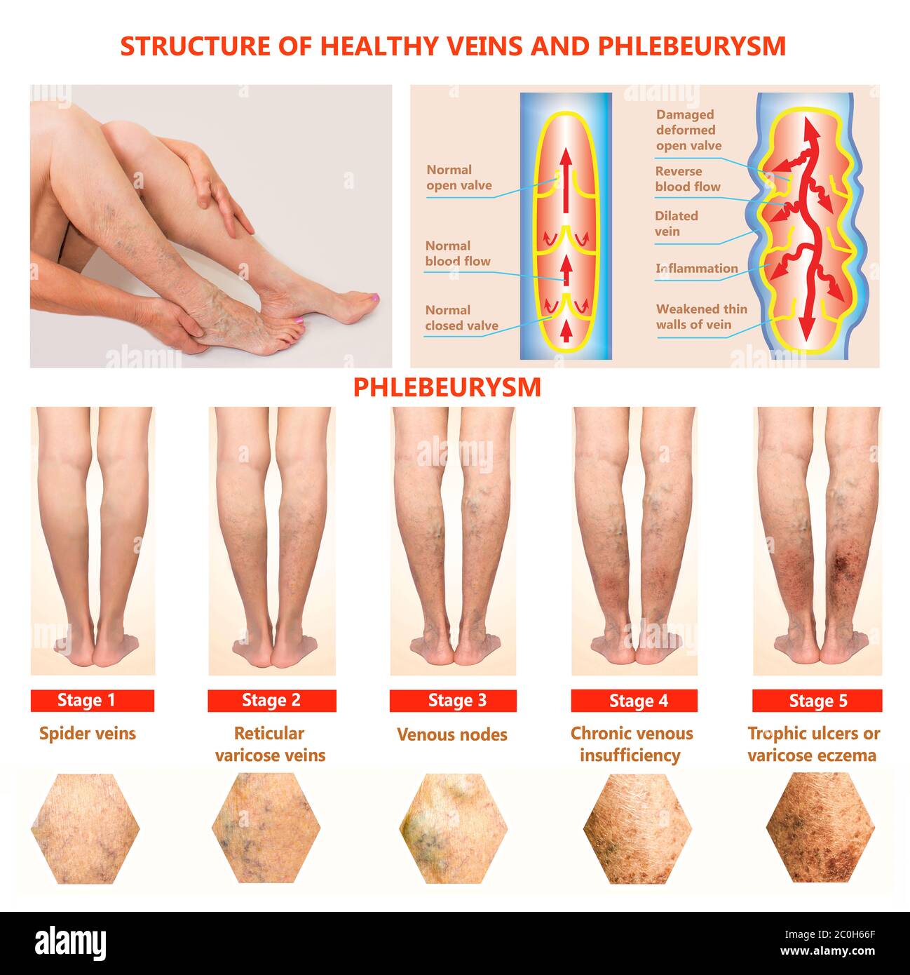 Blood clot legs Cut Out Stock Images & Pictures - Alamy