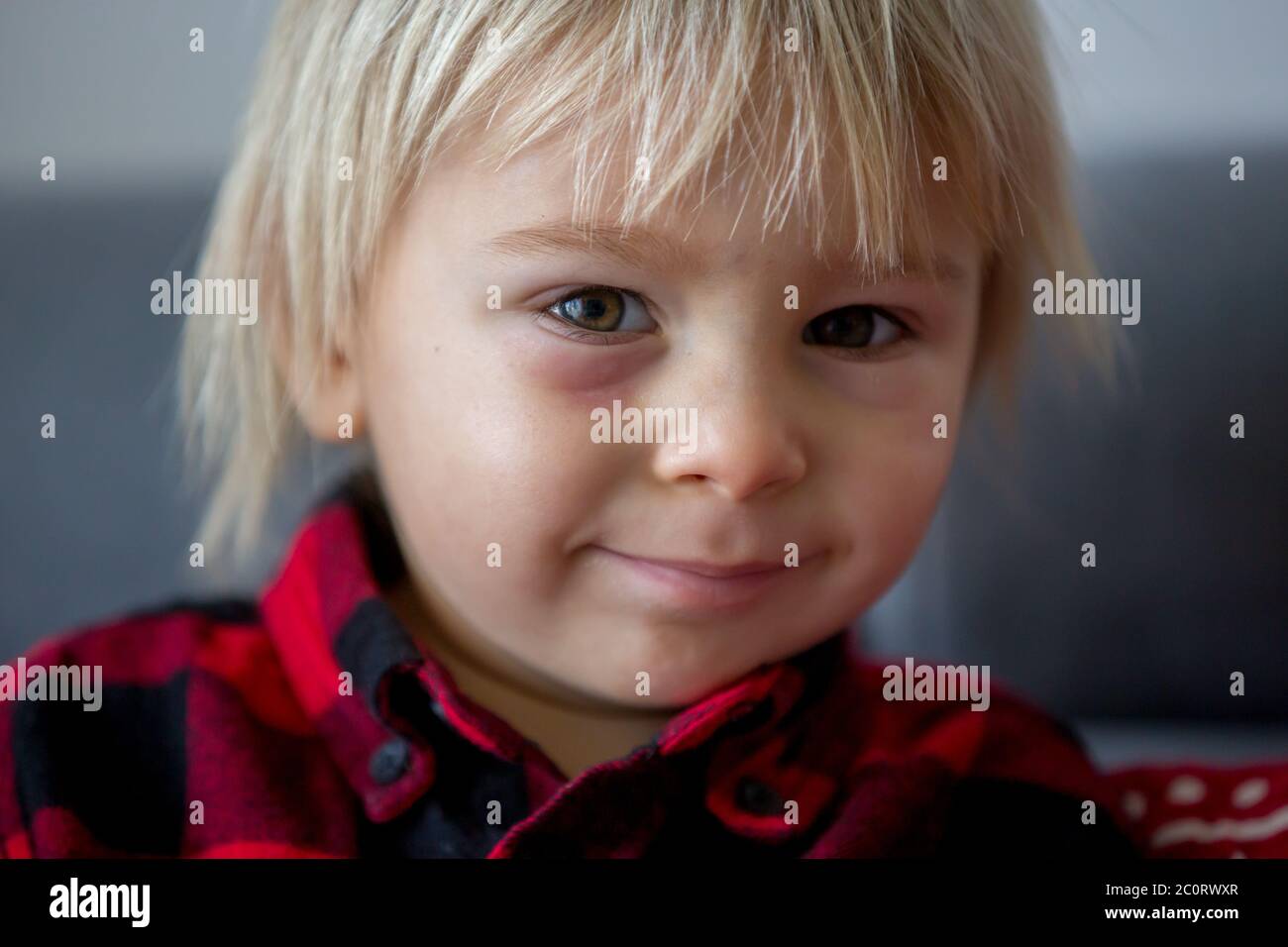 Blonde toddler boy with red burned spot under the eye, feeling pain