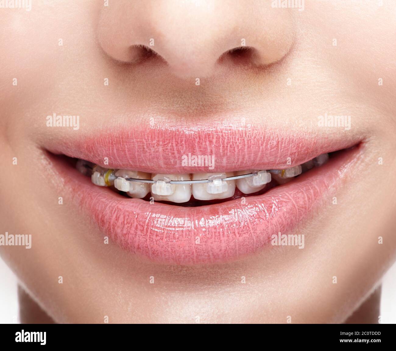 Closeup of woman open smiling mouth with  brackets Stock Photo