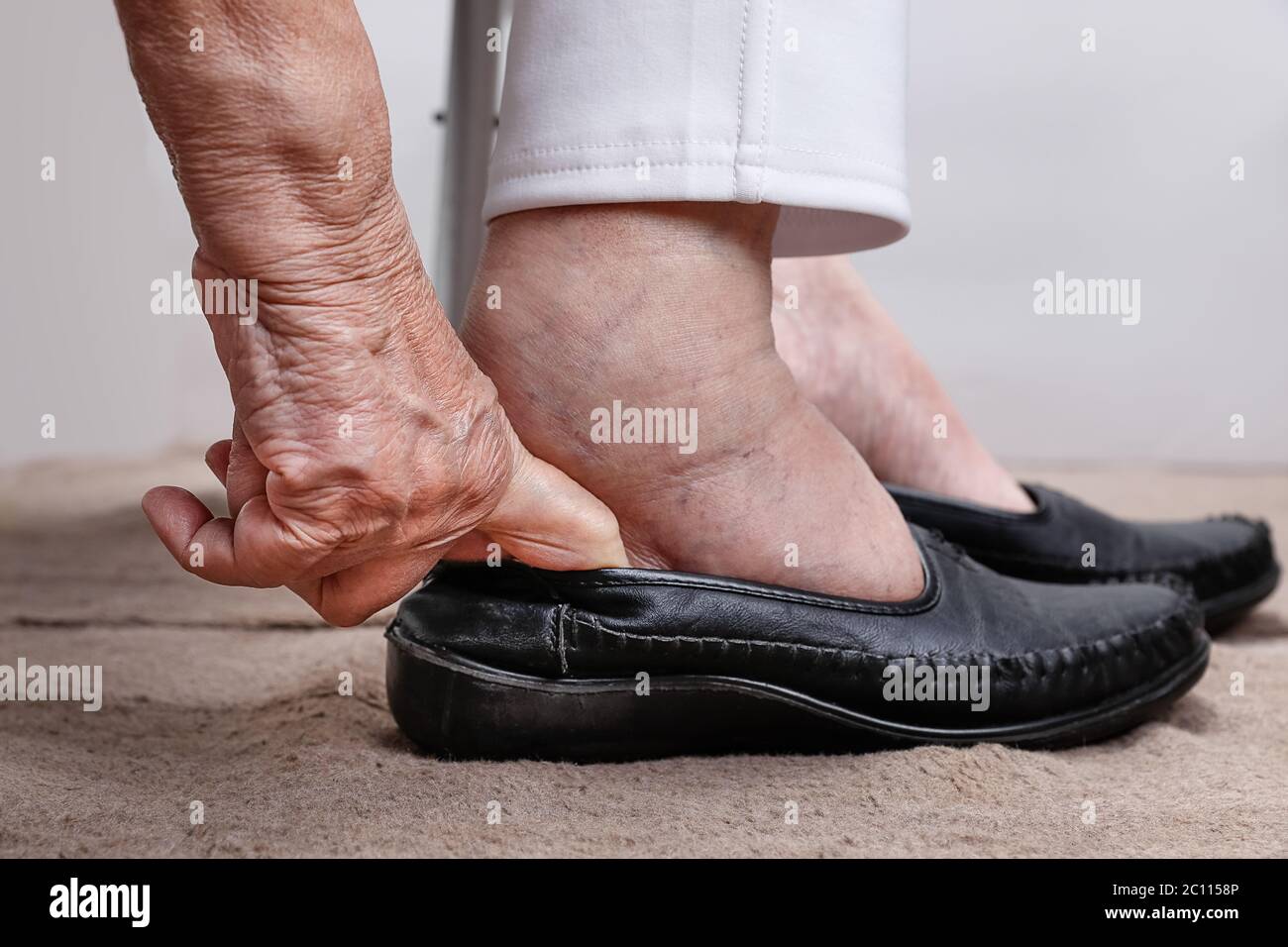 Liver disease skin hires stock photography and images Alamy