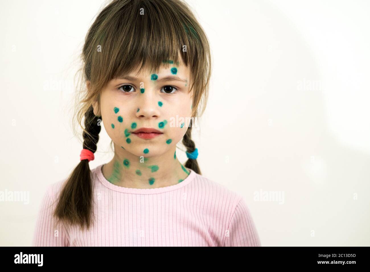 Child girl covered with green rashes on face ill with chickenpox, measles or rubella virus. Stock Photo