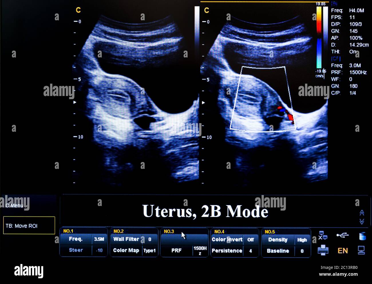 Colourful Ultrasound Monitor Image Uterus 2d Stock Photo Alamy