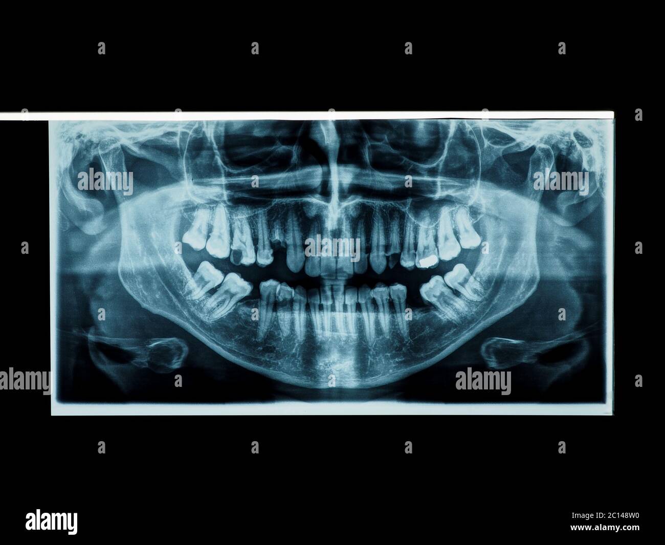 teeth panoramic xray Stock Photo Alamy