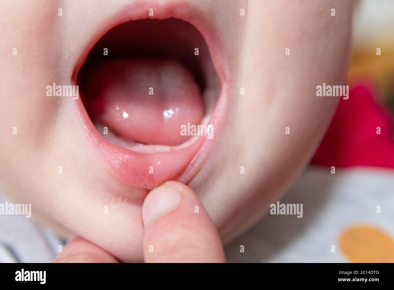 Young Teeth First Baby Milk Tooth High Resolution Stock Photography And Images Alamy