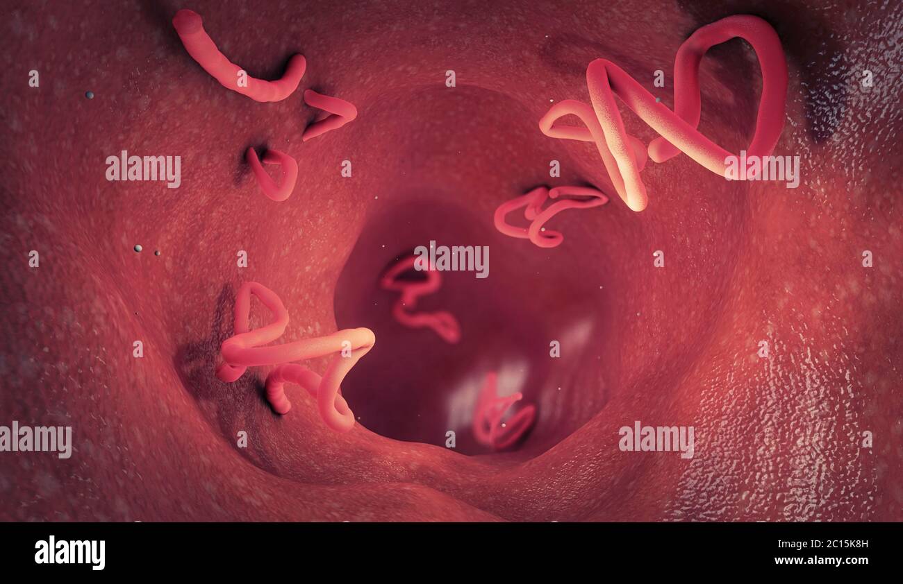 Tapeworm infestation in a human intestine - 3d illustration Stock Photo