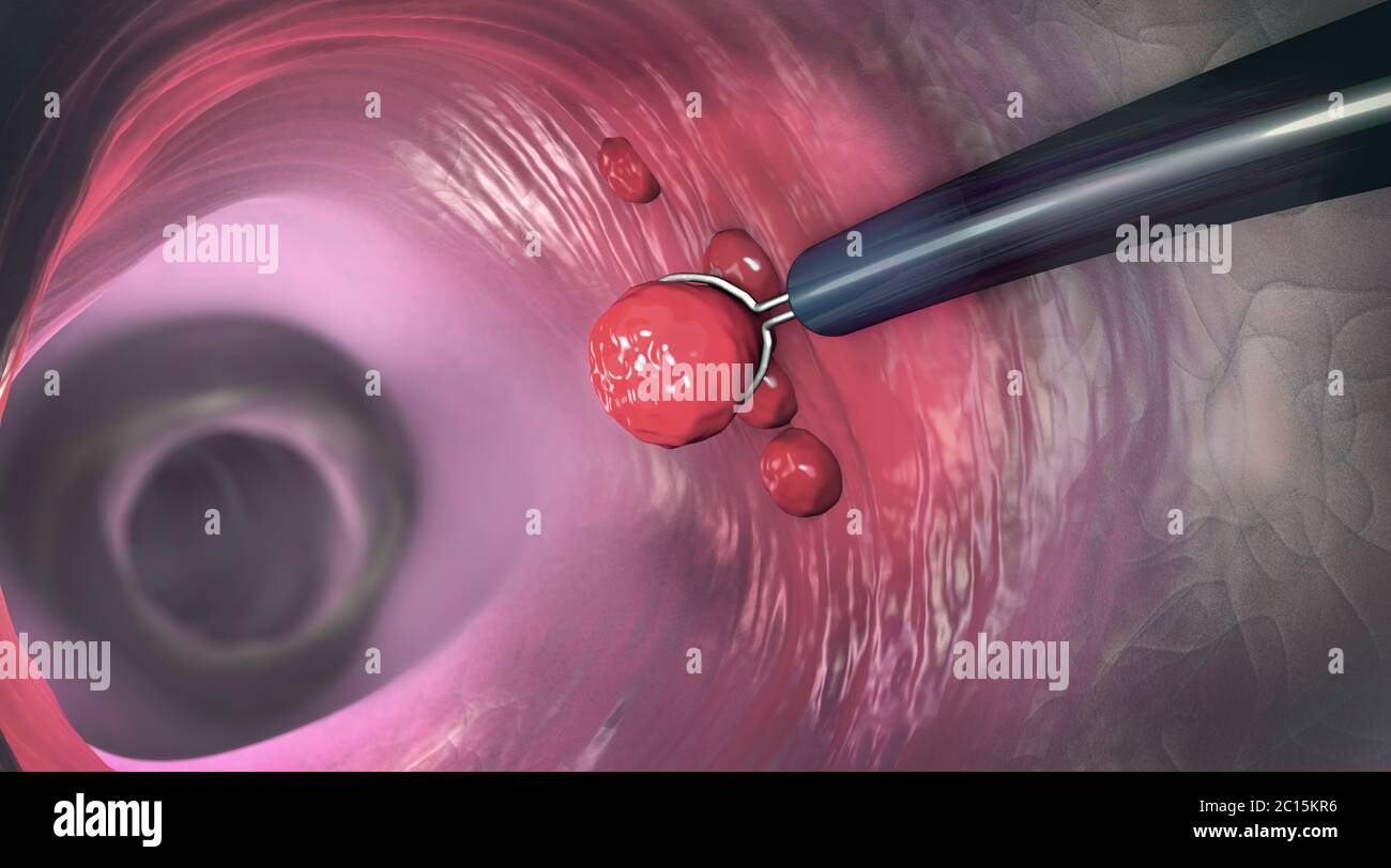 Colon Clip Removal of a colonic polyp with a electrical wire loop during a ...