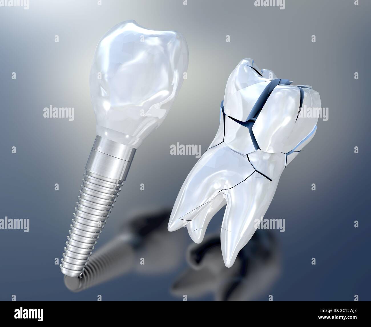 3d illustration of a broken white tooth an a tooth implant Stock Photo