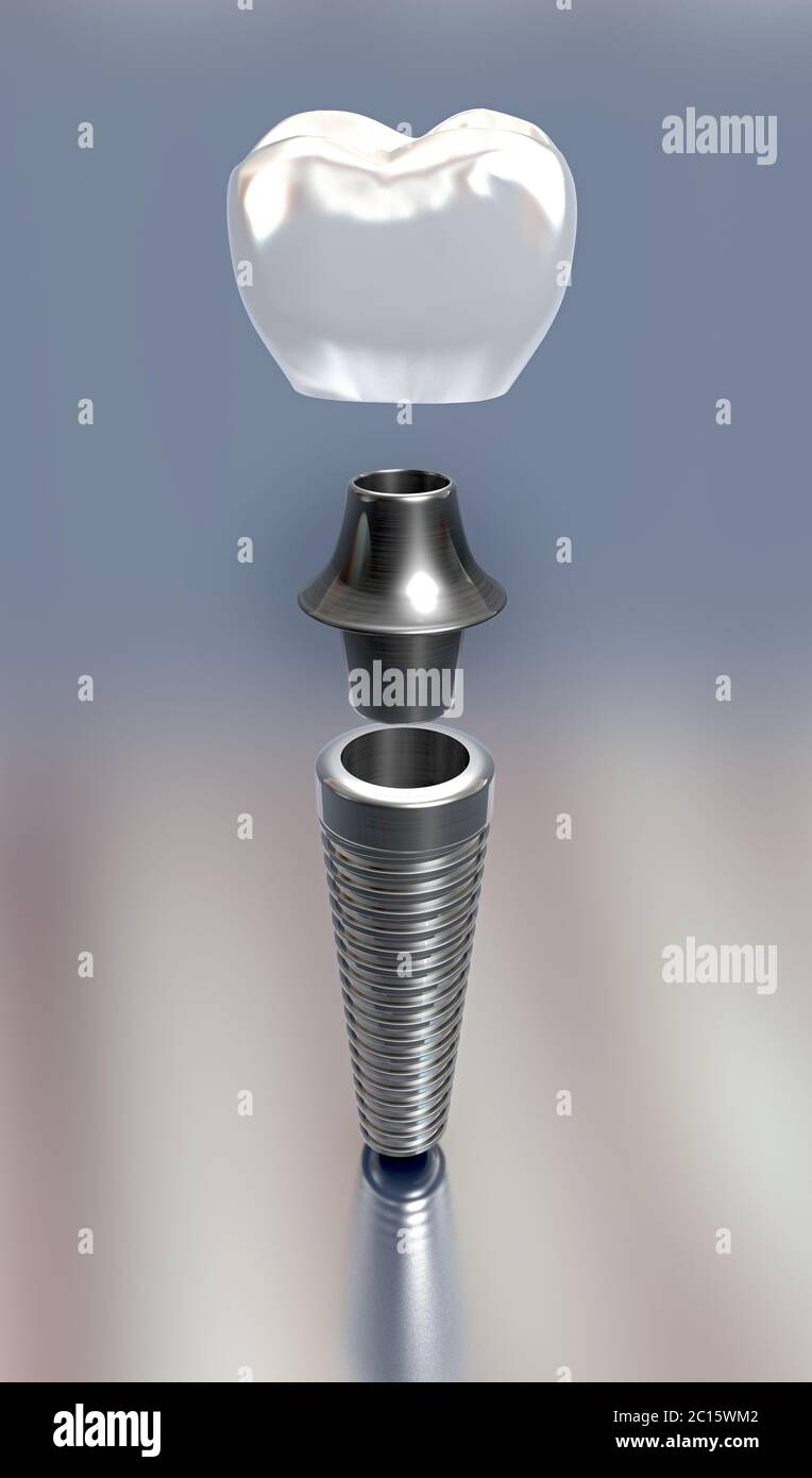 3d illustration of three different parts of a tooth implant Stock Photo
