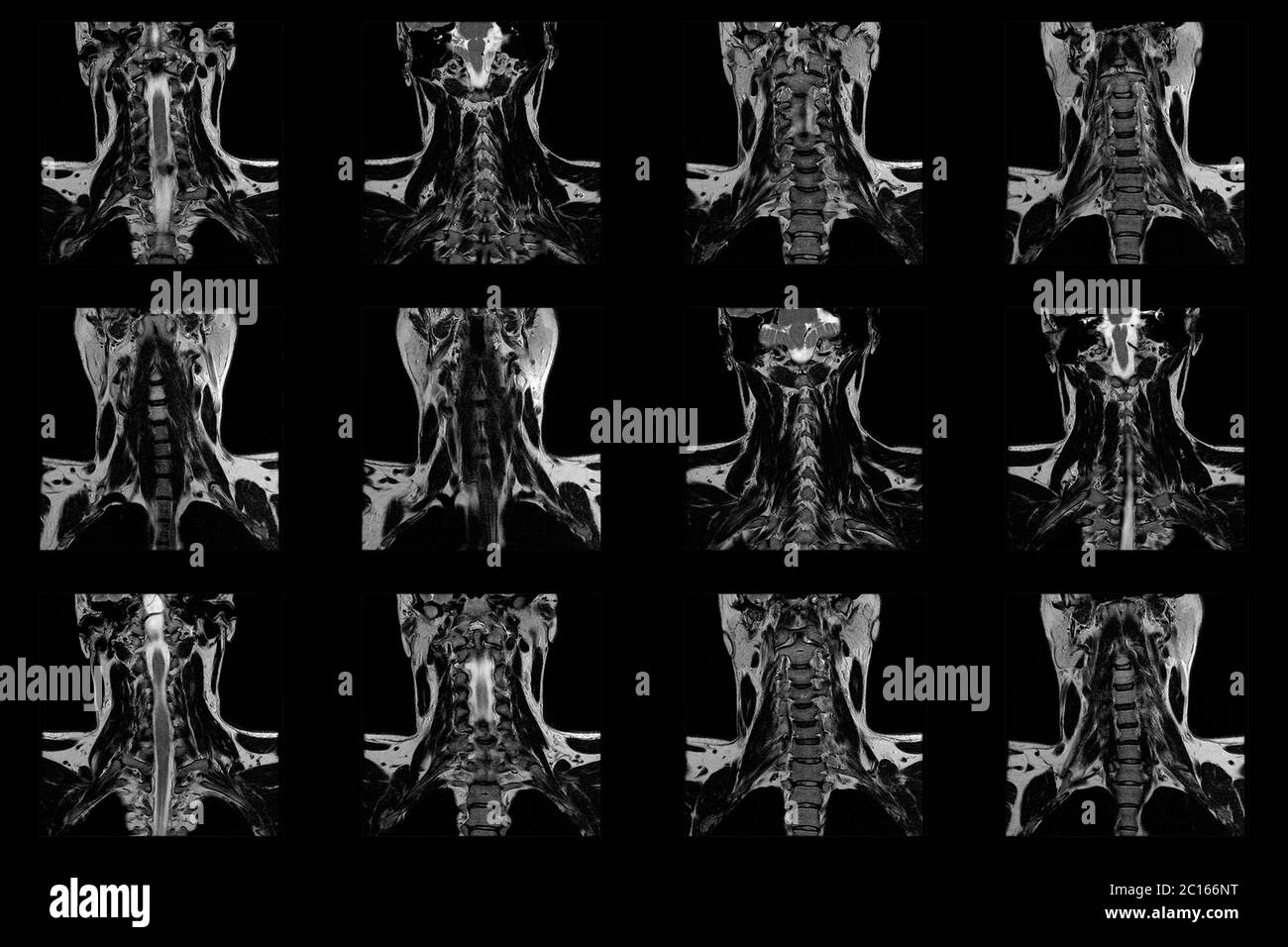 set of coronal MRI scans of neck area of caucasian male with bilateral paramedial extrusion of the C6-C7 segment with radiculopathy Stock Photo