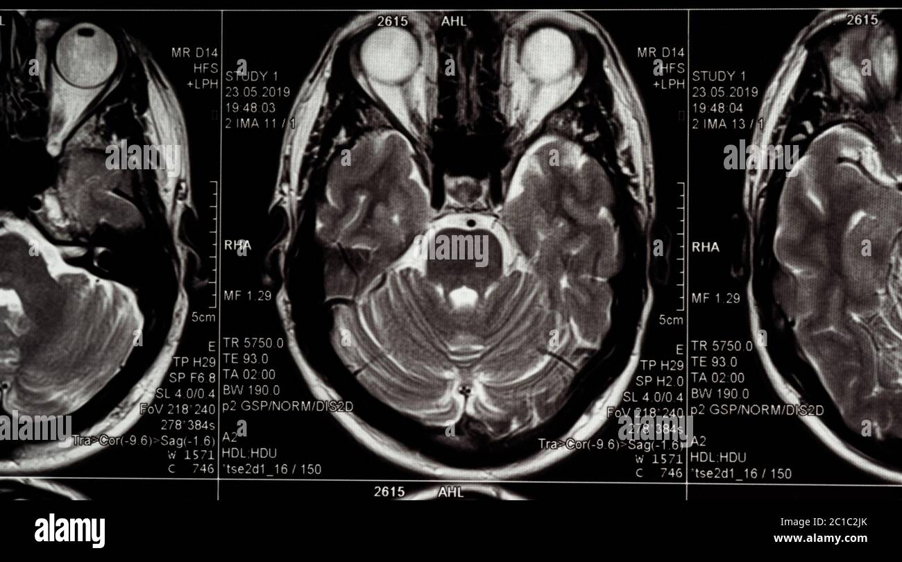 Brain MRI slide of a young man, eyes are seen Stock Photo