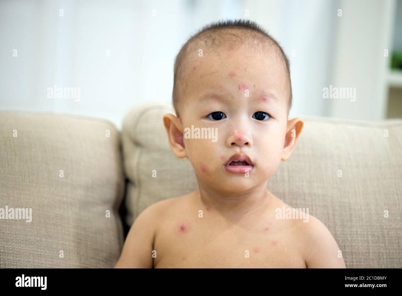 Asian twenty months old baby sitting on couch with red spots of chickenpox, natural photo. Stock Photo