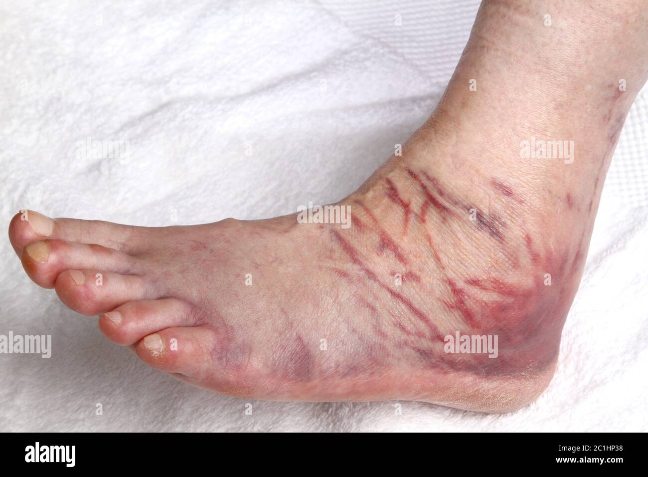 ligament rupture on ankle joint Stock Photo