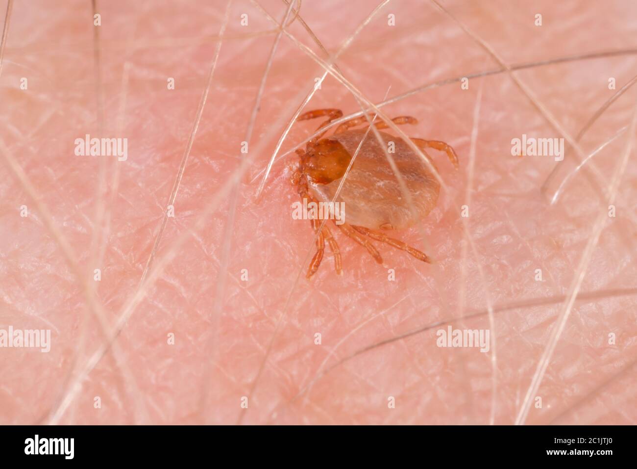 Tick drinking blood biting human skin Stock Photo