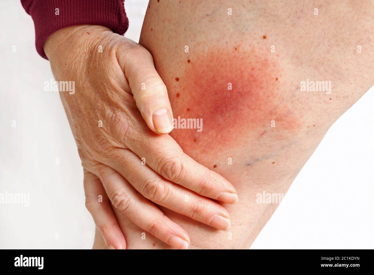 Wandering flush Lyme borreliosis of the leg of a woman transmitted by a tick. Lyme disease caused by a tick bite on the thigh. Stock Photo
