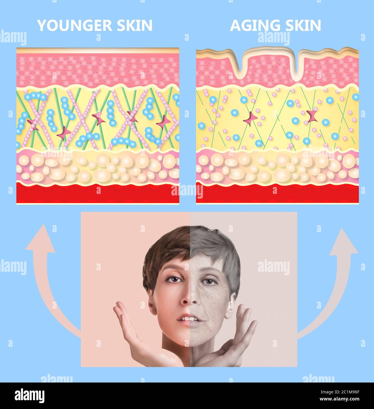 The younger skin and aging skin. elastin and collagen. A diagram of young and old face showing the decrease in collagen and broken elastin. Stock Photo