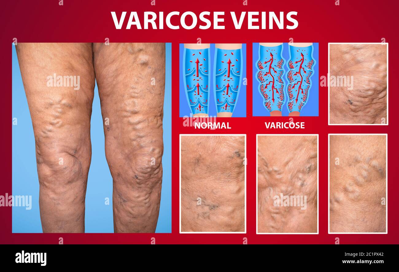 The old age and sick of a woman. Varicose veins on a legs of woman. The varicosity, spider veins, edema, illness concept. Stock Photo