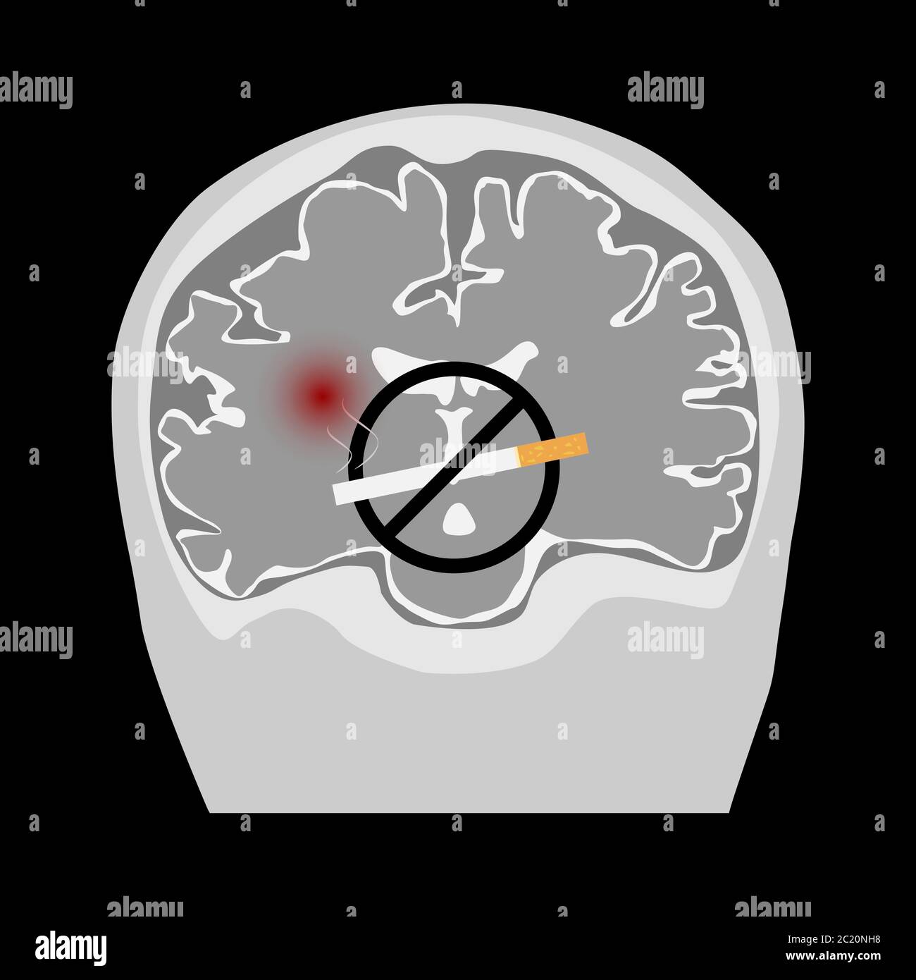 Ischemic stroke hires stock photography and images Alamy