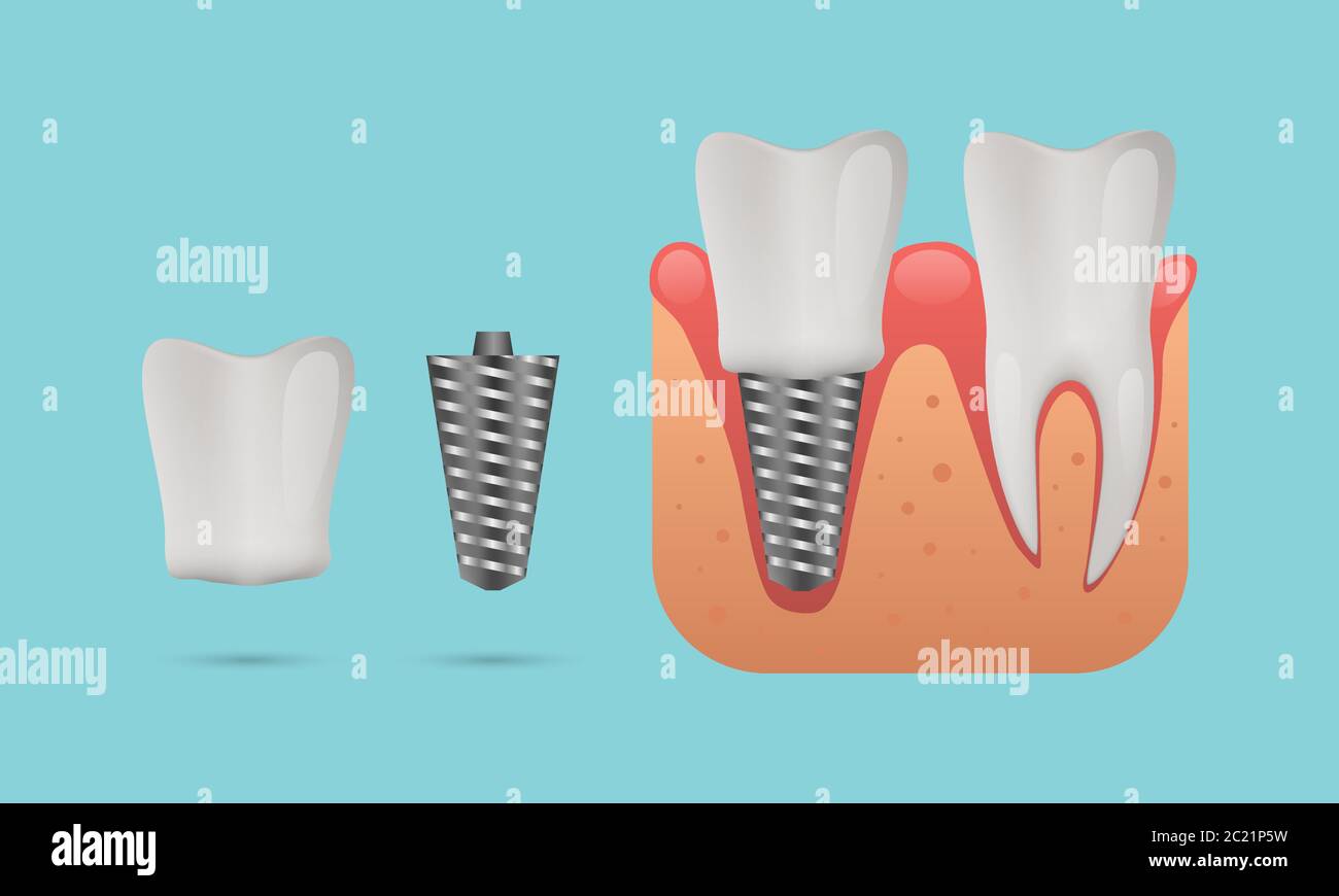 Dental implant structure, human teeth and dental implant, vector