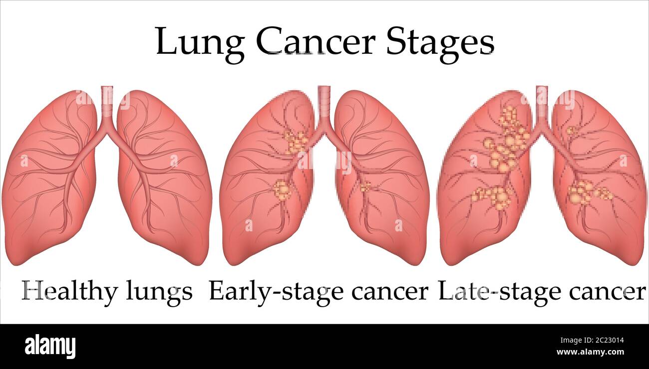 Book lungs hi-res stock photography and images - Alamy