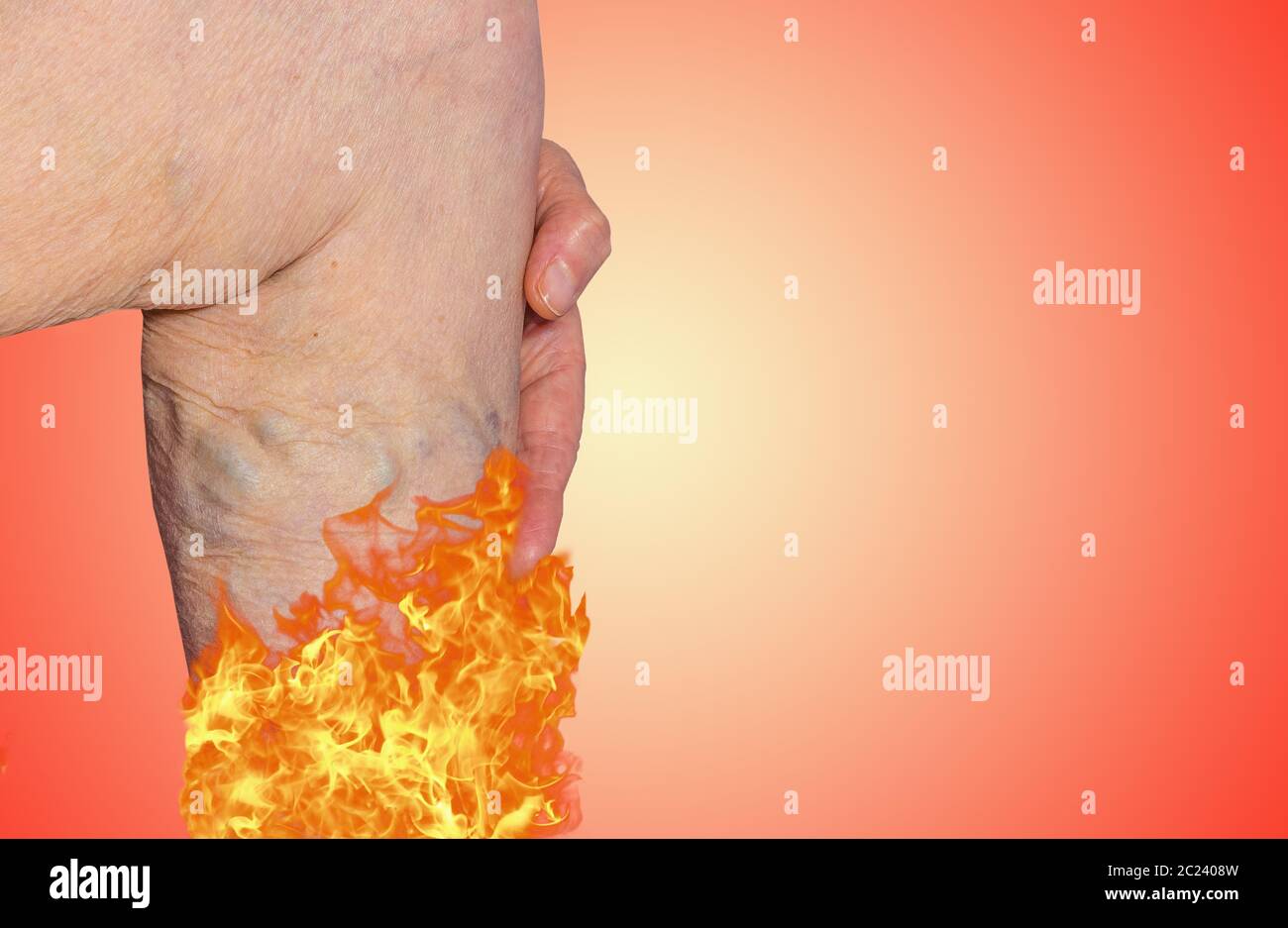 Varicose veins on a legs of old woman in fire. The varicose, spider veins, edema, illness concept. Senior pensioner woman with hands on legs. Stock Photo