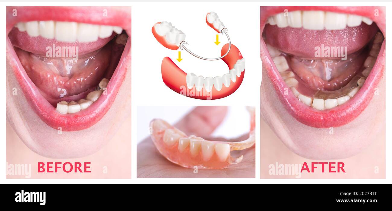dental-rehabilitation-with-lower-flexible-nylon-denture-before-and